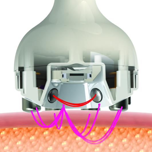Venus Legacy Multipolarní radiofrekvence How radiofrequency works