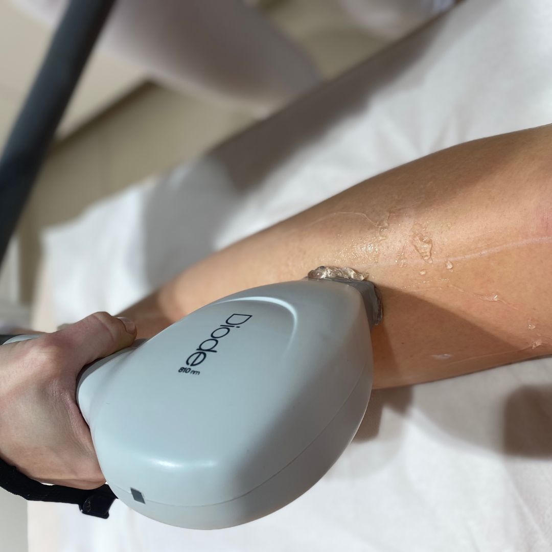 Laser hair removal treatment how it looks